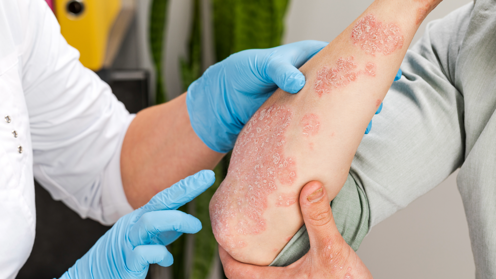 Dermatologist performing laser therapy for psoriasis treatment in Nashville
