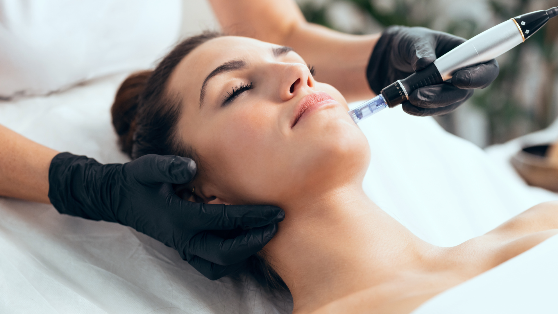 Microneedling procedure for collagen stimulation and wrinkle reduction